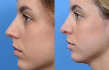 young female patient before and after rhinoplasty - left side
