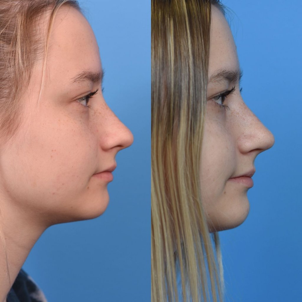 teenage girl before and after rhinoplasty - right side