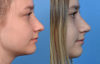 teenage girl before and after rhinoplasty - right side