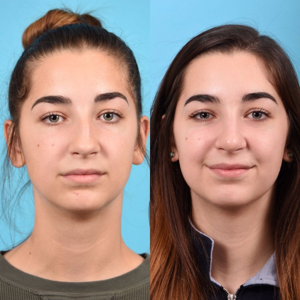 teenage female patient before and after rhinoplasty - front