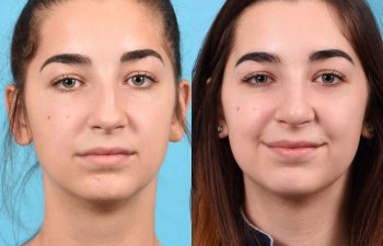 teenage female patient before and after rhinoplasty - front