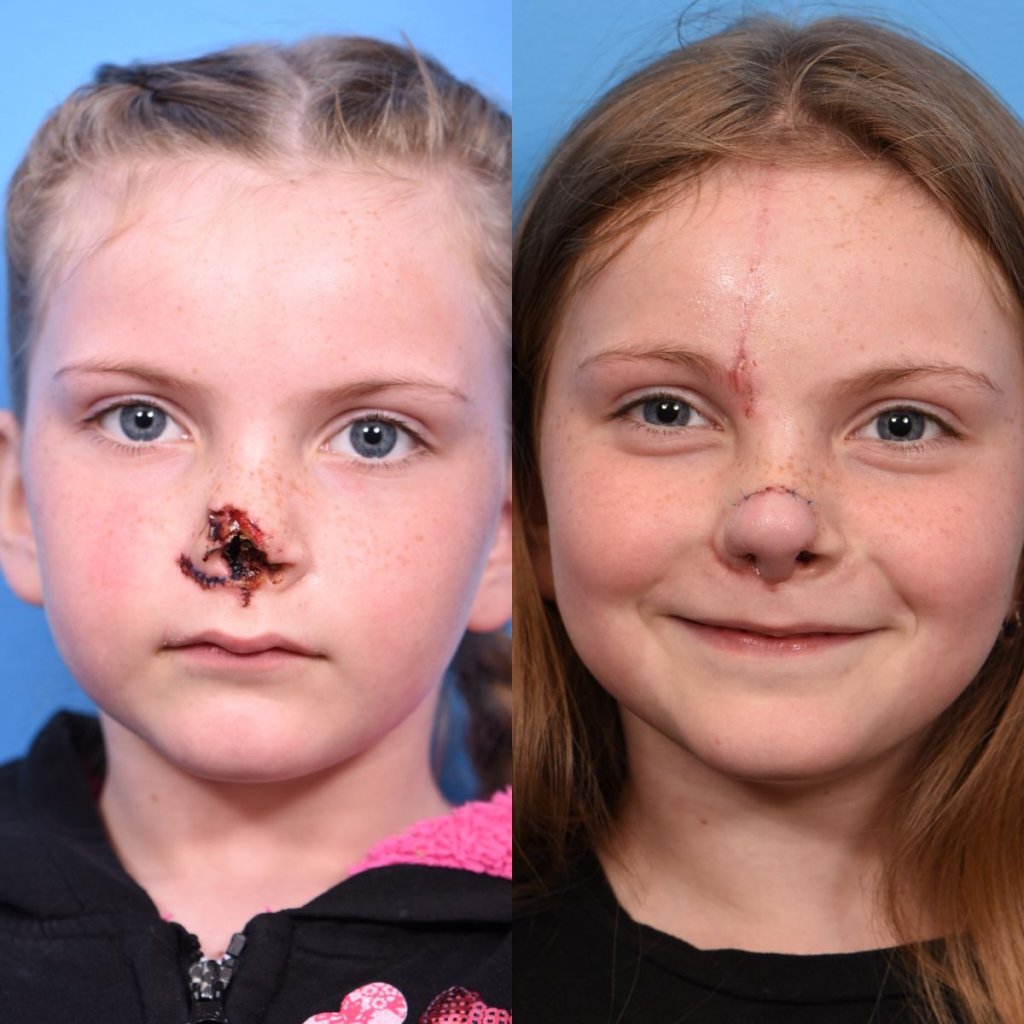 little girl before and after nose reconstructive surgery