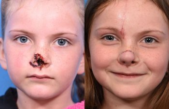 little girl before and after nose reconstructive surgery