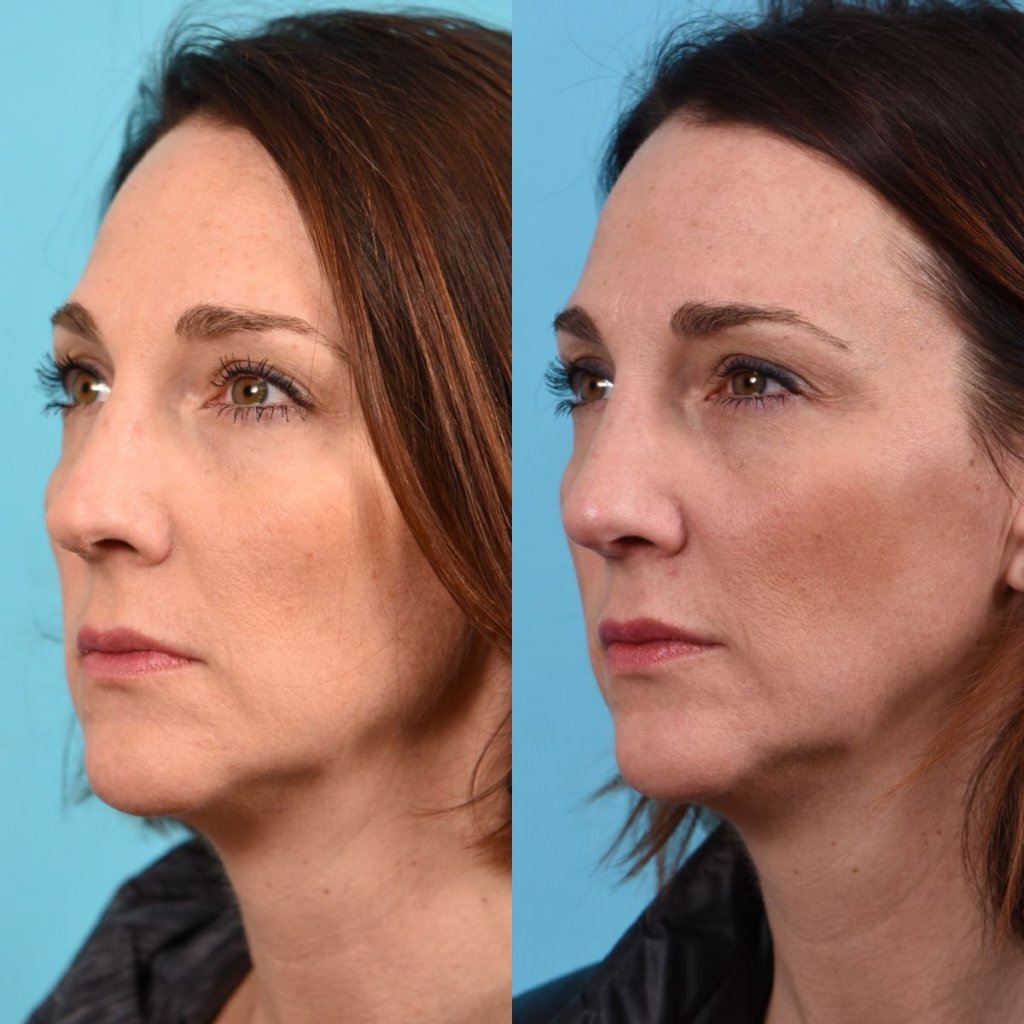 female patient before and after rhinoplasty - left side