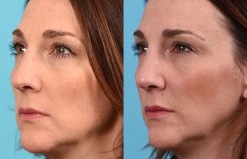 female patient before and after rhinoplasty - left side