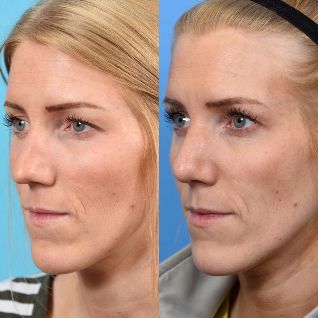 female patient before and after rhinoplasty - left side