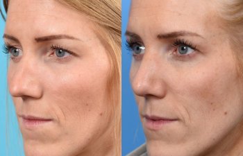 female patient before and after rhinoplasty - left side