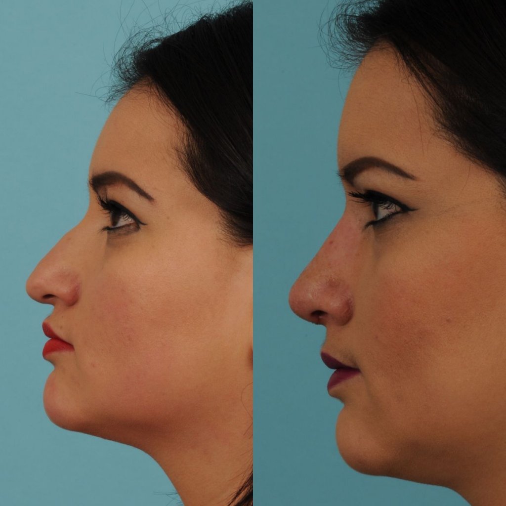 female patient before and after rhinoplasty - left side