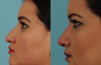 female patient before and after rhinoplasty - left side