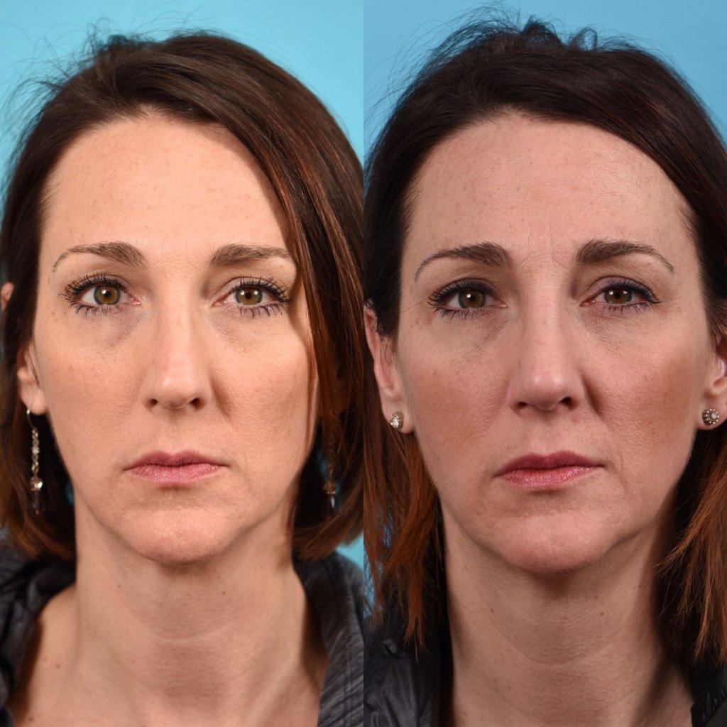female patient before and after rhinoplasty - front