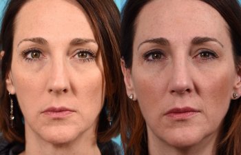 female patient before and after rhinoplasty - front