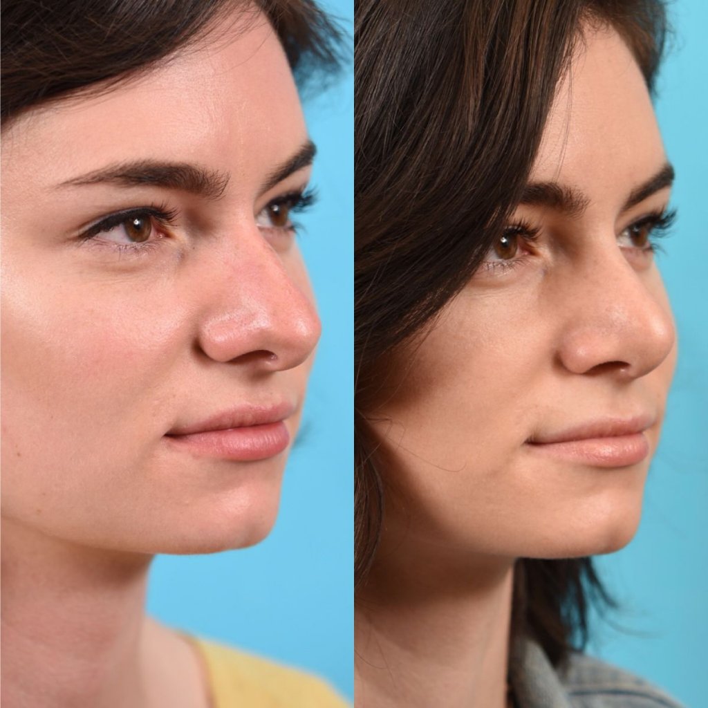 female patient before and after rhinoplasty - right side
