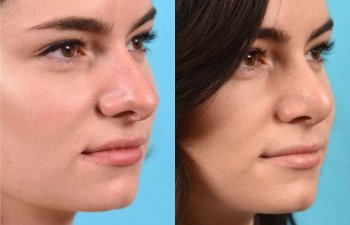 female patient before and after rhinoplasty - right side