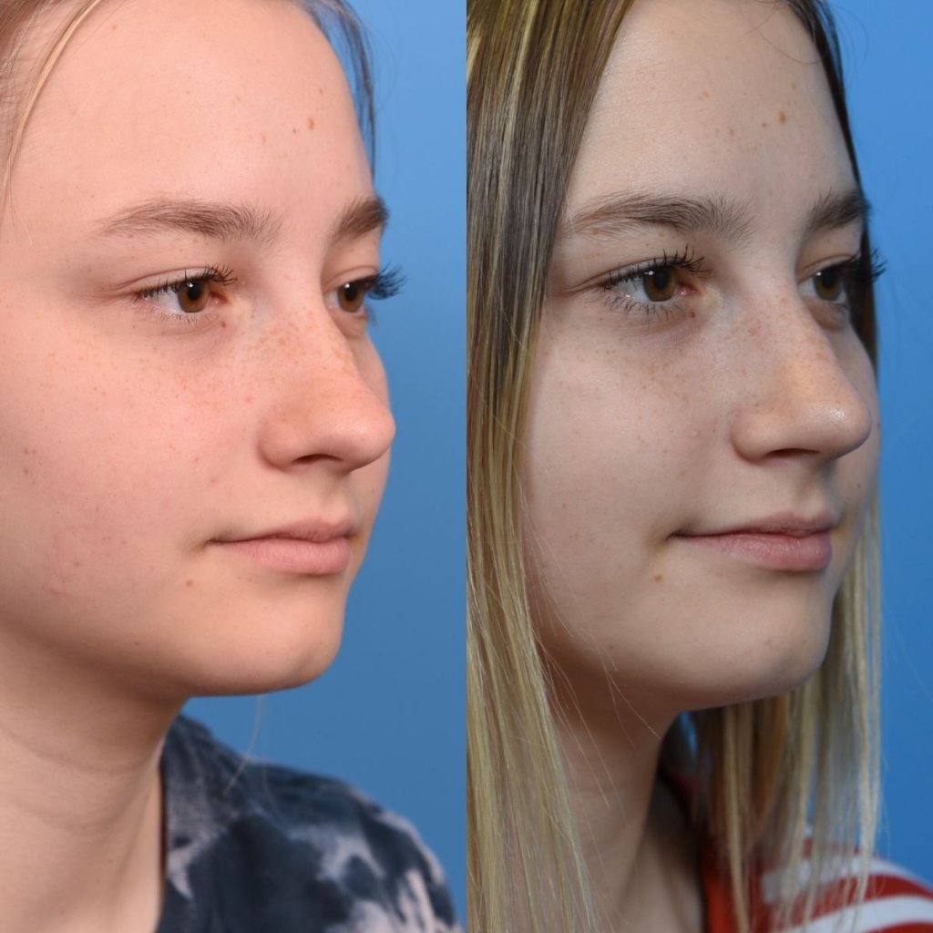 teenage girl before and after rhinoplasty - right side