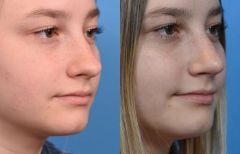 teenage girl before and after rhinoplasty - right side