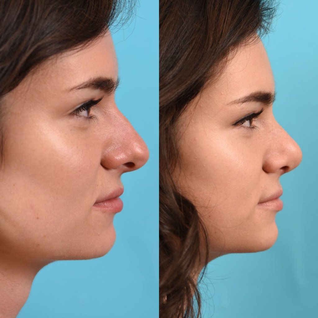 female patient before and after rhinoplasty - right side