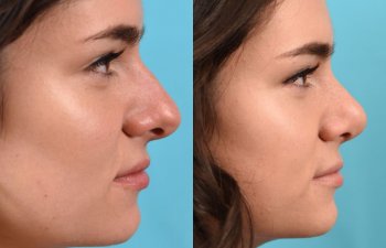 female patient before and after rhinoplasty - right side
