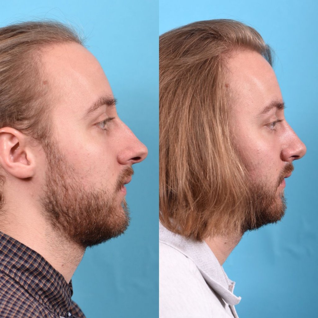 male patient before and after rhinoplasty - right side
