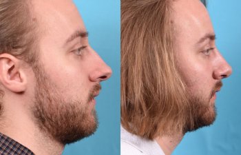 male patient before and after rhinoplasty - right side