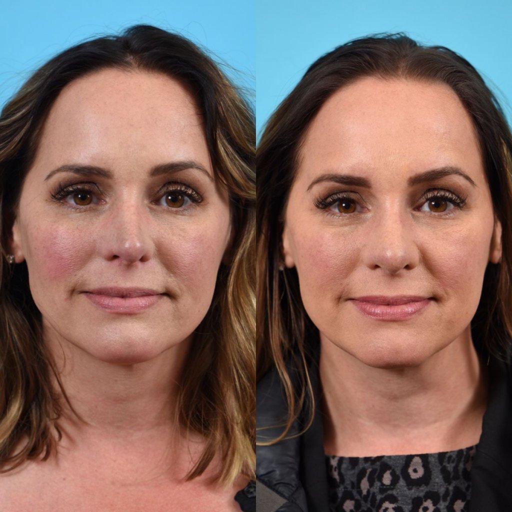 female patient before and after rhinoplasty - front