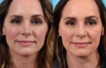 female patient before and after rhinoplasty - front