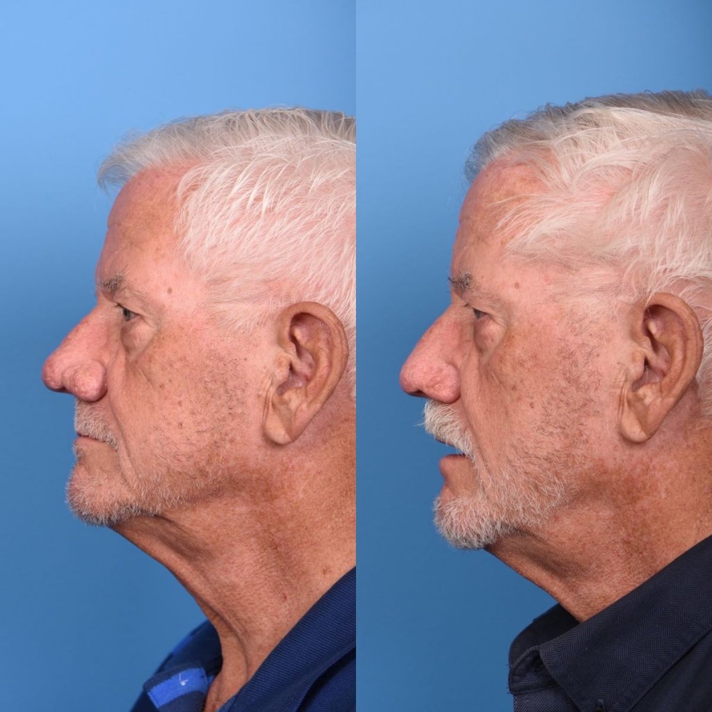 patient before and after nasal reconstructive surgery