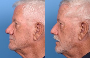 patient before and after nasal reconstructive surgery