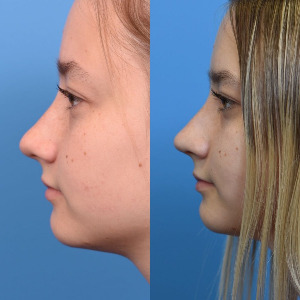 teenage girl before and after rhinoplasty - left side