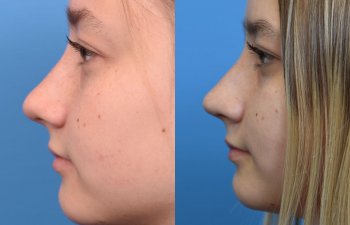 teenage girl before and after rhinoplasty - left side