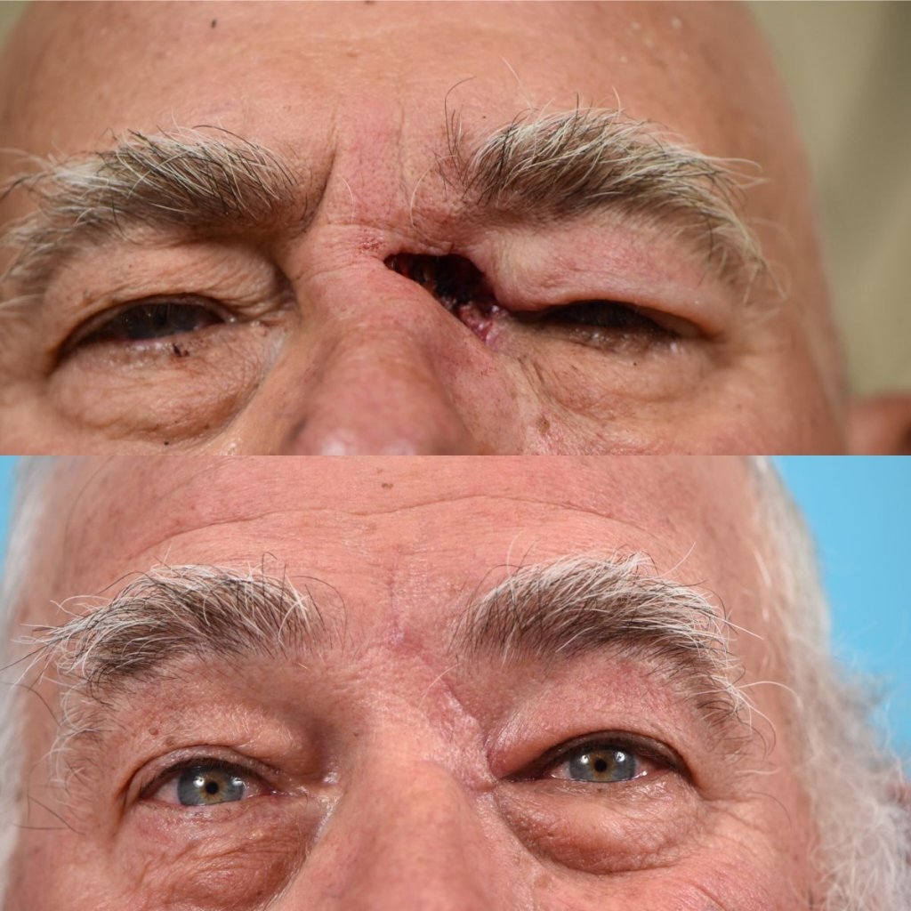 patient before and after MOHS reconstructive surgery