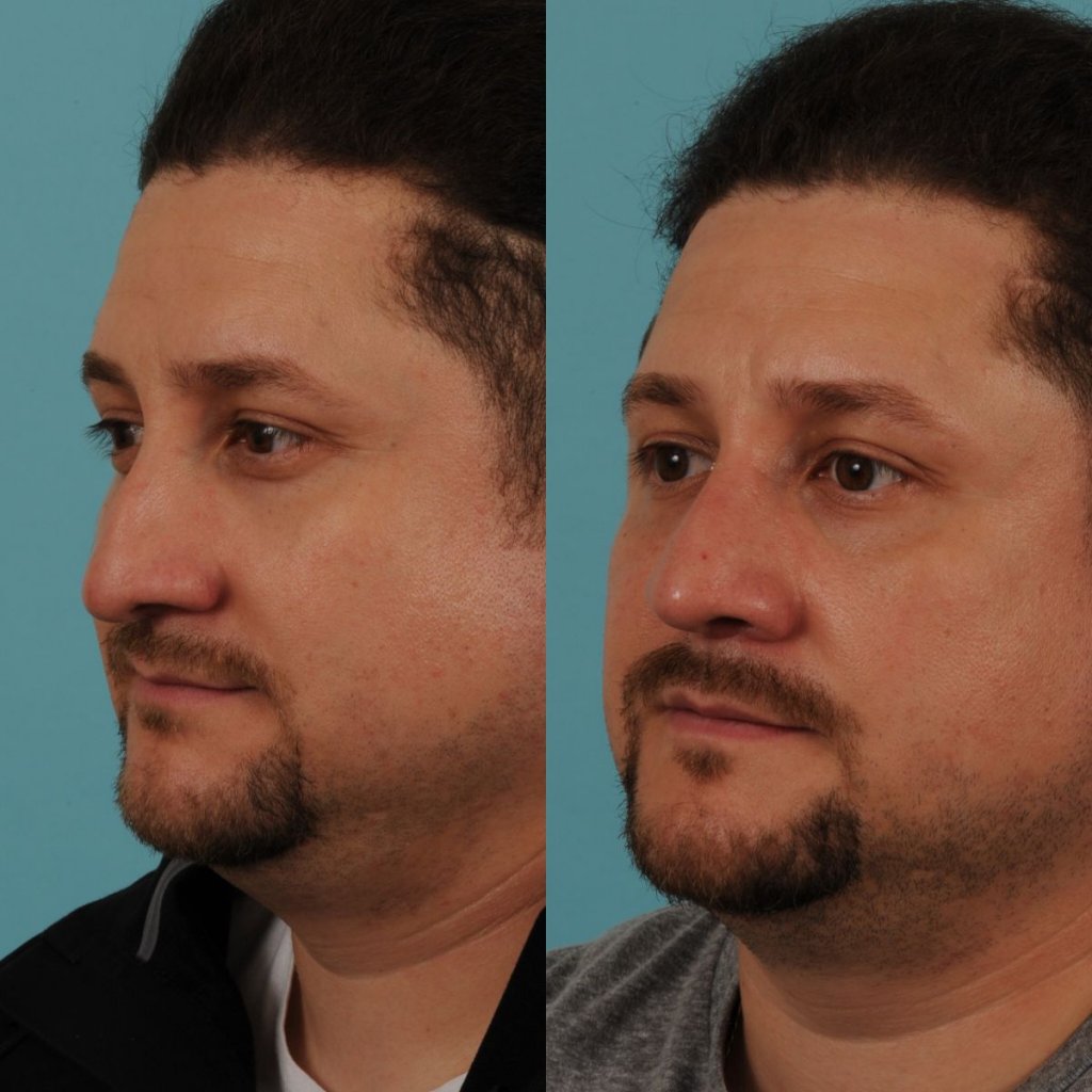male patient before and after rhinoplasty - left side