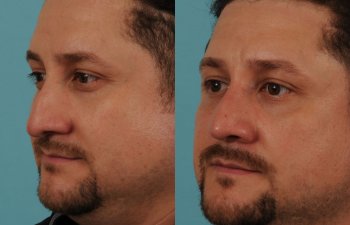 male patient before and after rhinoplasty - left side