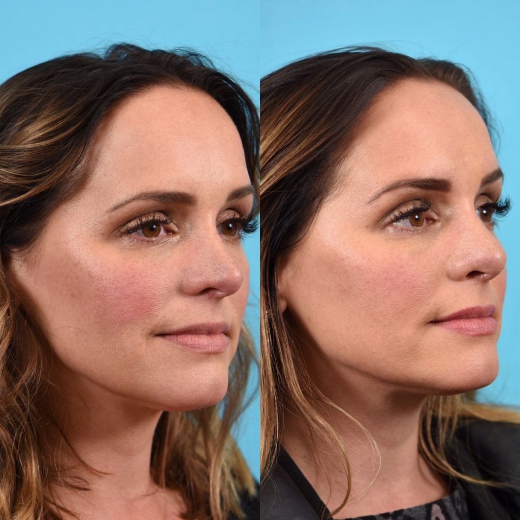 female patient before and after rhinoplasty - right side