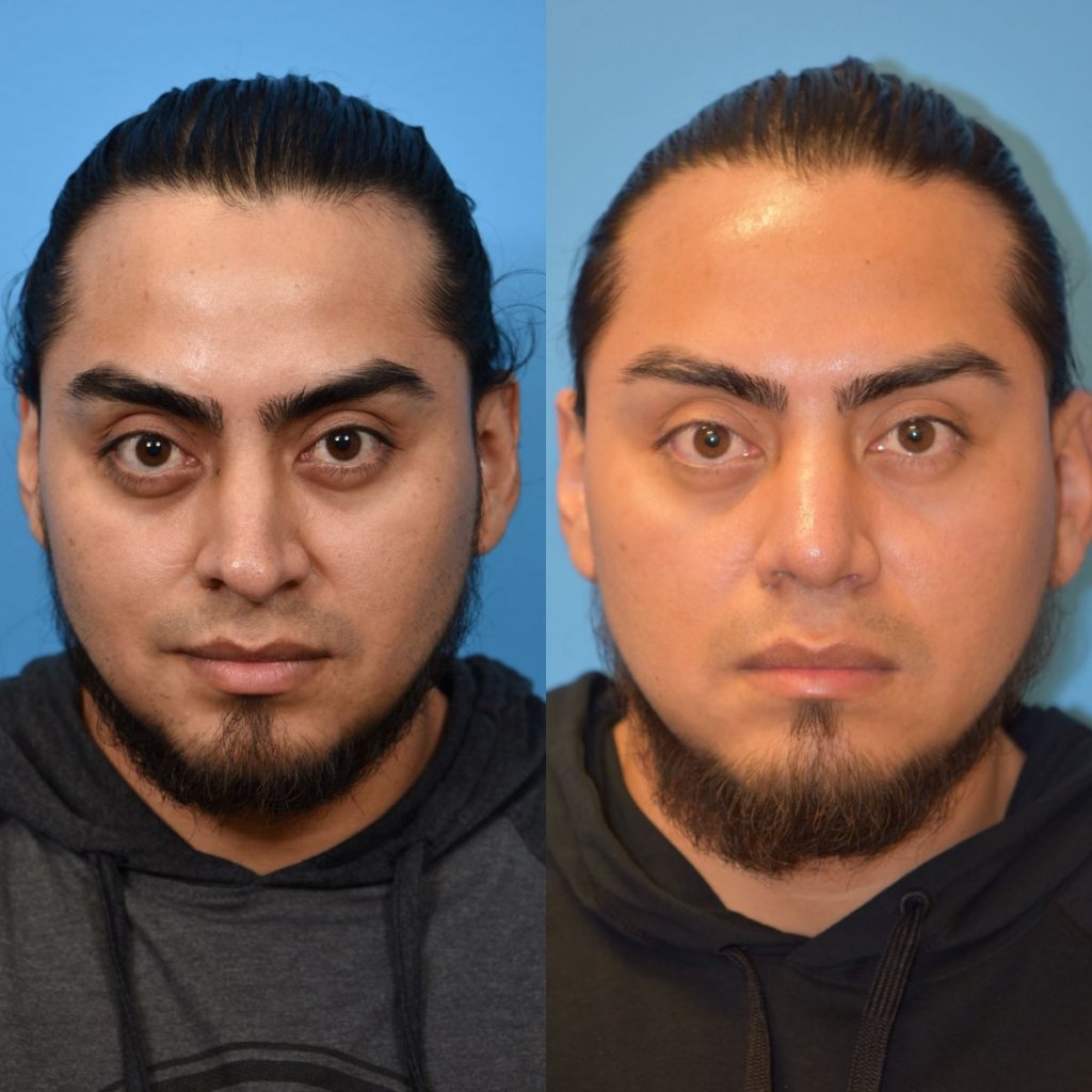 male patient before and after rhinoplasty - front
