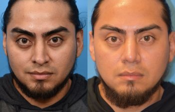 male patient before and after rhinoplasty - front