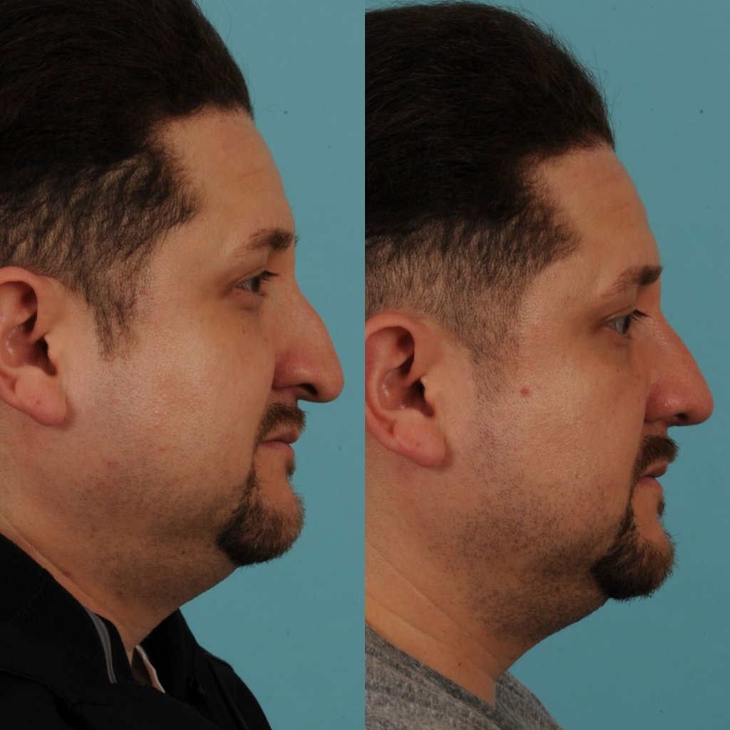 male patient before and after rhinoplasty - right side