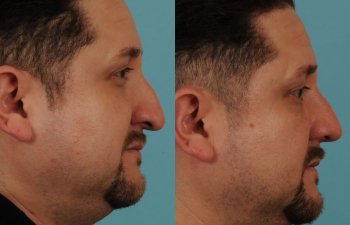 male patient before and after rhinoplasty - right side