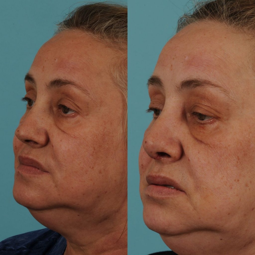 female patient before and after rhinoplasty - left side