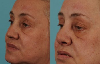 female patient before and after rhinoplasty - left side
