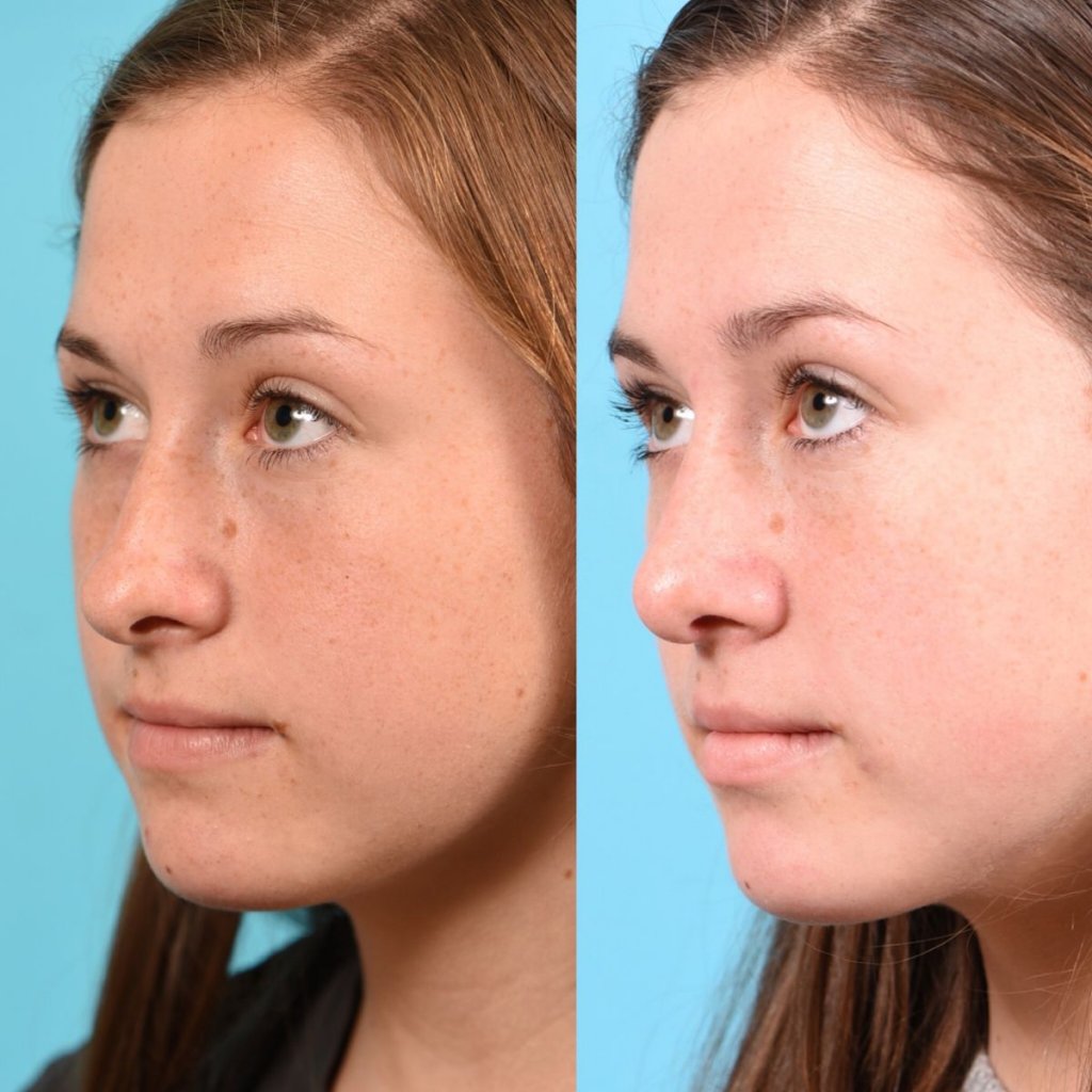 teenage girl before and after rhinoplasty - left side