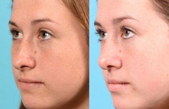 teenage girl before and after rhinoplasty - left side