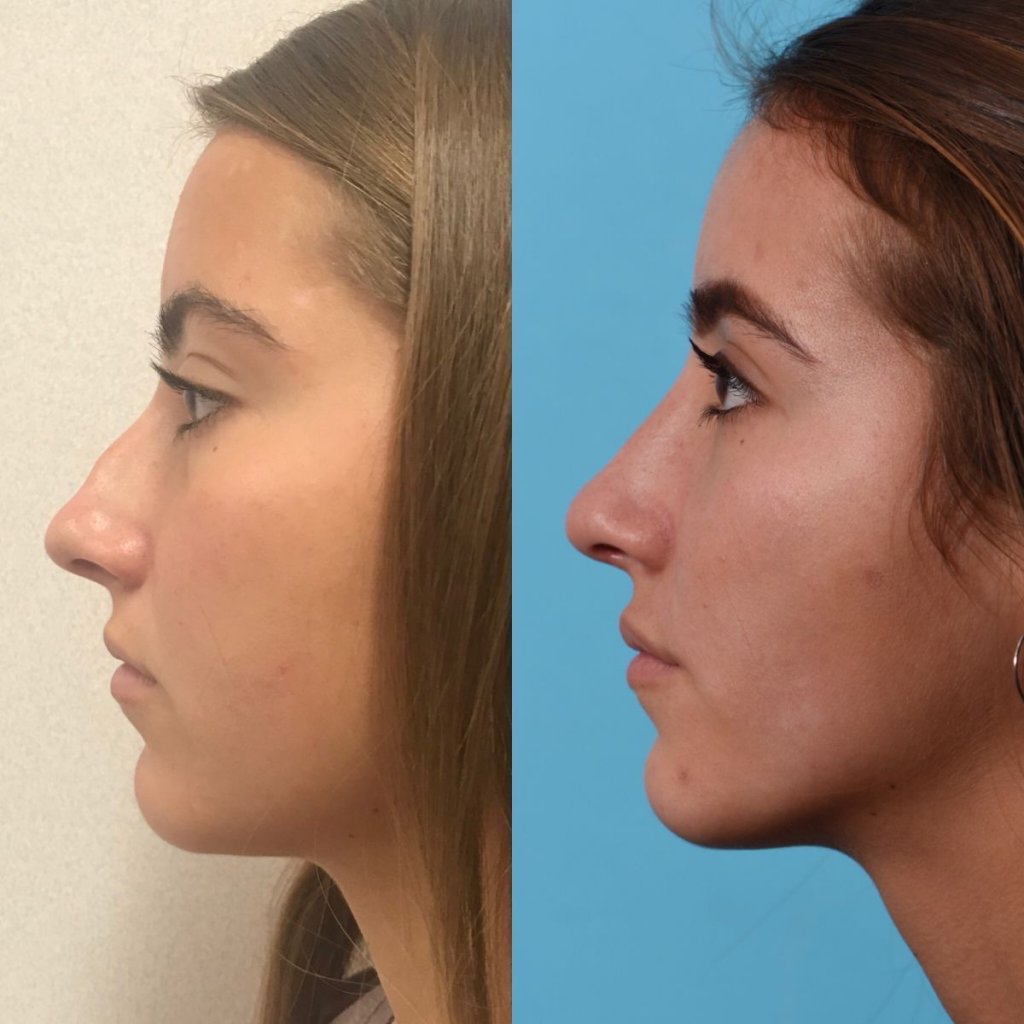 female patient before and after rhinoplasty - left side
