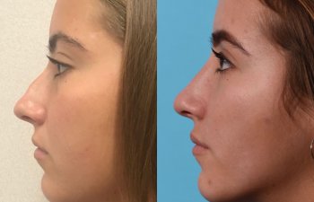 female patient before and after rhinoplasty - left side