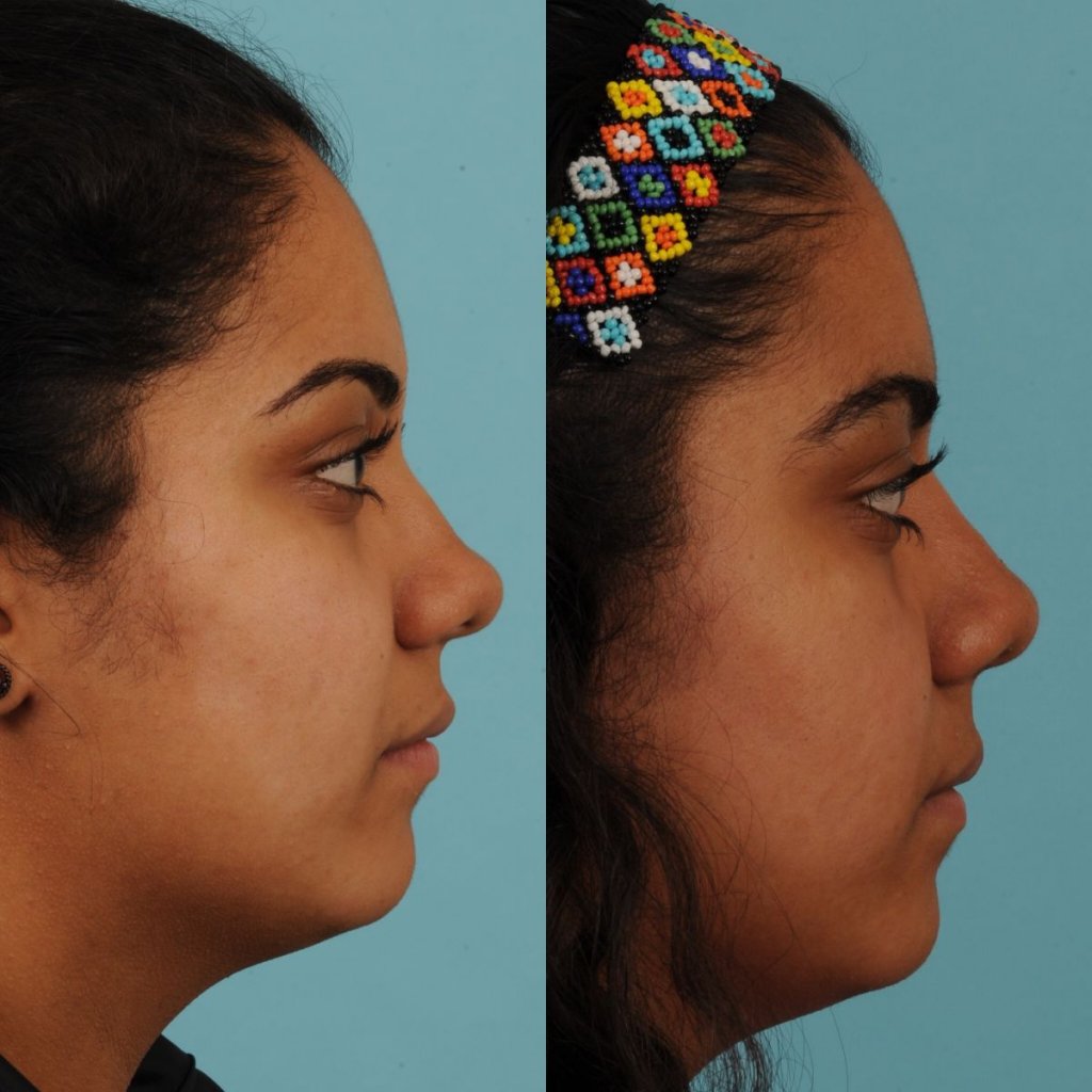 female patient before and after rhinoplasty - right side