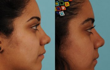 female patient before and after rhinoplasty - right side