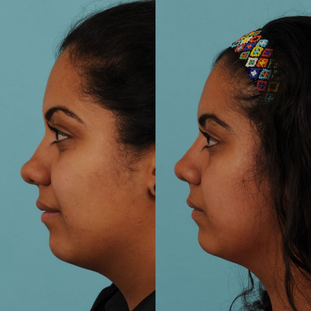 female patient before and after rhinoplasty - left side