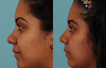 female patient before and after rhinoplasty - left side