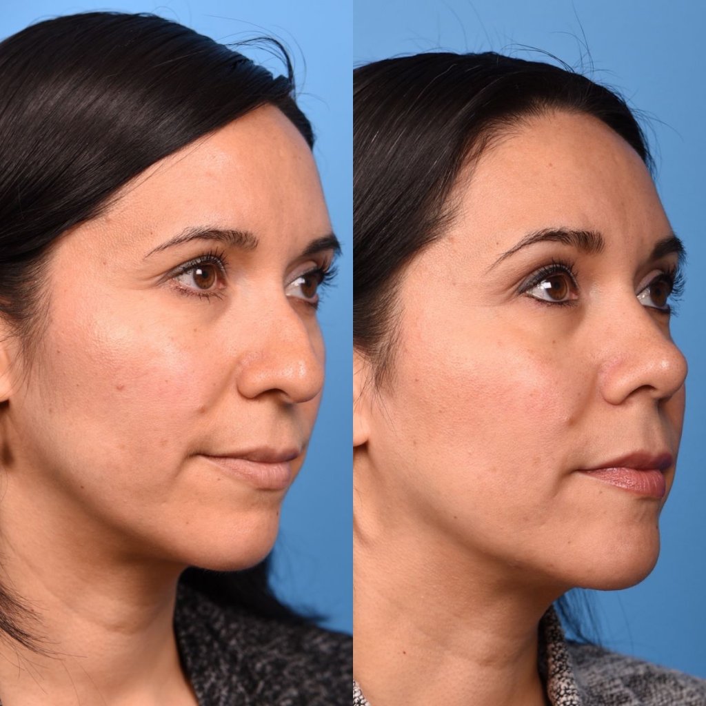young female patient before and after rhinoplasty - righ side