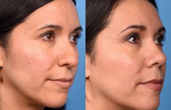 young female patient before and after rhinoplasty - righ side