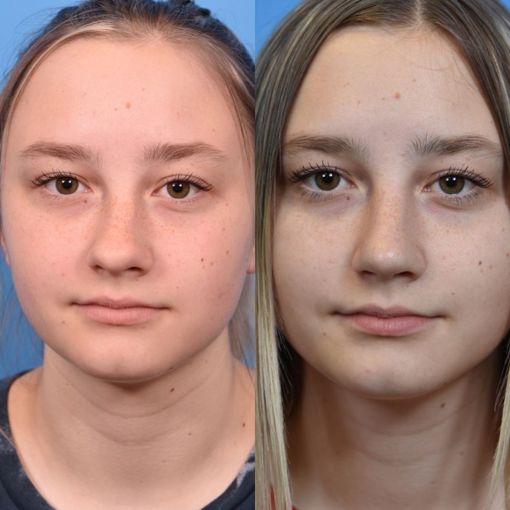 teenage girl before and after rhinoplasty - front